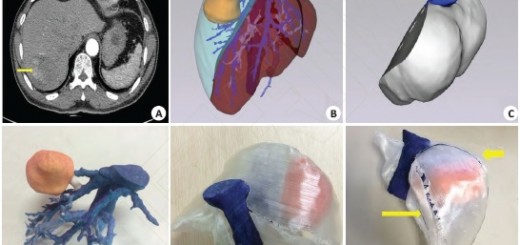 3D打印在肝脏肿瘤手术中的应用