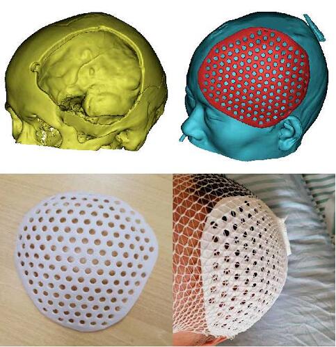 3D打印“保护帽”帮助修复缺损颅骨