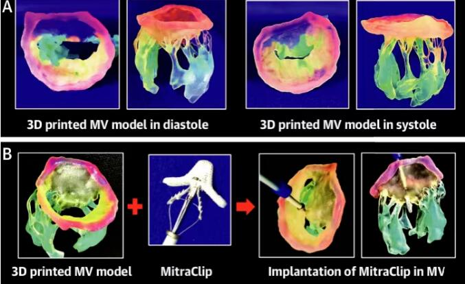 西京医院：3D打印、计算机建模和人工智能在结构性心脏病中的应用展望