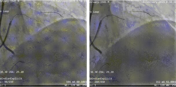 wenzhou hospital_PCI 4