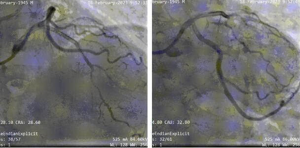 wenzhou hospital_PCI 5
