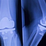knee implants